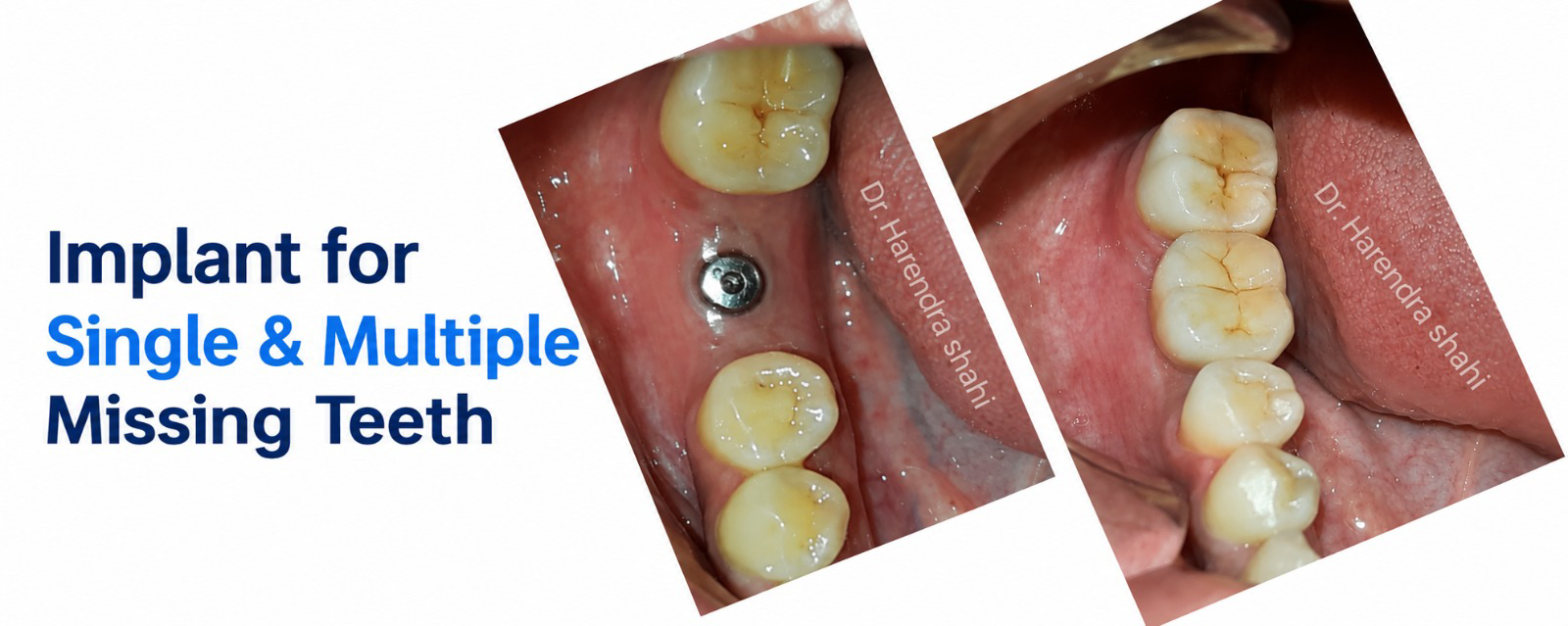 Implant for single and multiple missing teeth
