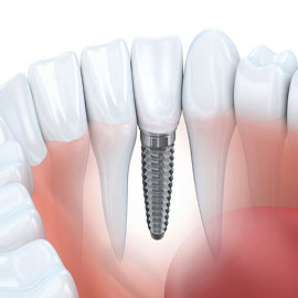 Dental Implant Specialist – Prosthodontist