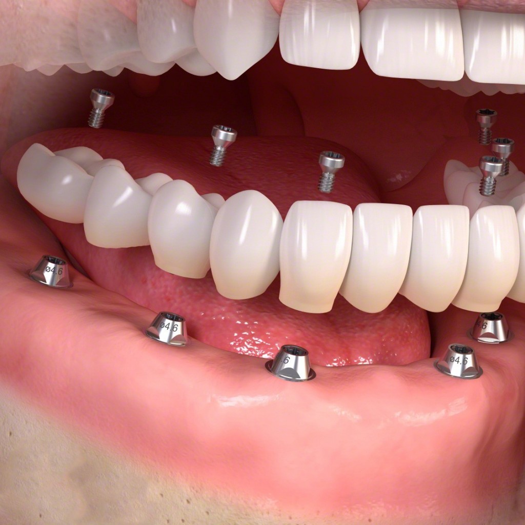 fixedimplant-3d-dental-implant-clinic