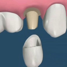 Total Digital Implant Dentistry